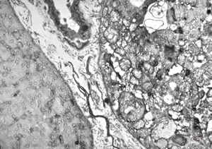 F,25y. | myopathy - atrophic and regenerating muscle cells F,25y. | myopathy - atrophic and regenerating muscle cells